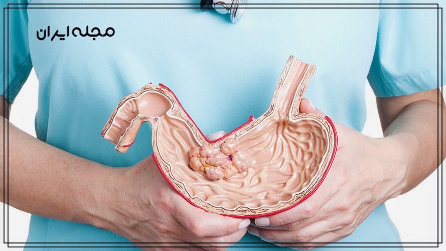 مصرف زیاد نمک خطر ابتلا به سرطان معده